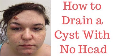 the cut should look like this () grabbing underneath the cyst, gently squeeze out the contents. . How to bring a cyst to a head overnight